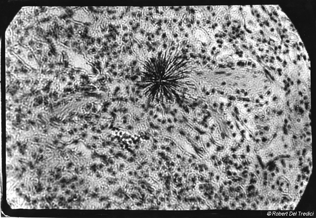 D5. Particle of Plutonium in Lung Tissue.